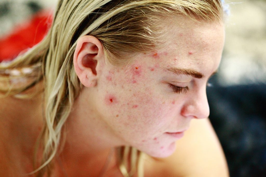 Purulent Pimples